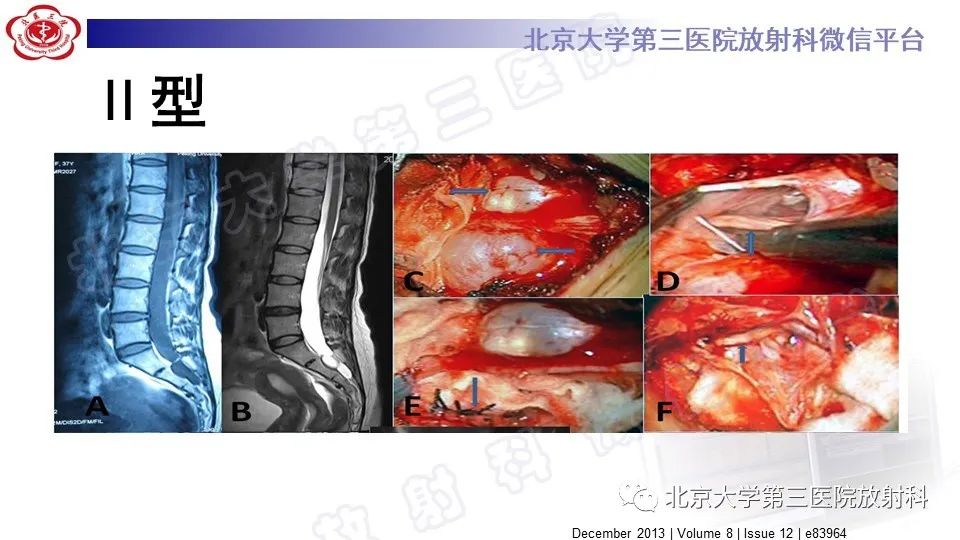 影像PPT - 【PPT】椎管内脊膜囊肿-29