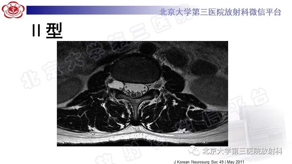 影像PPT - 【PPT】椎管内脊膜囊肿-30