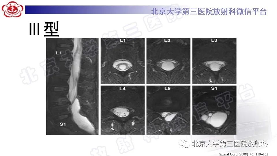 影像PPT - 【PPT】椎管内脊膜囊肿-33