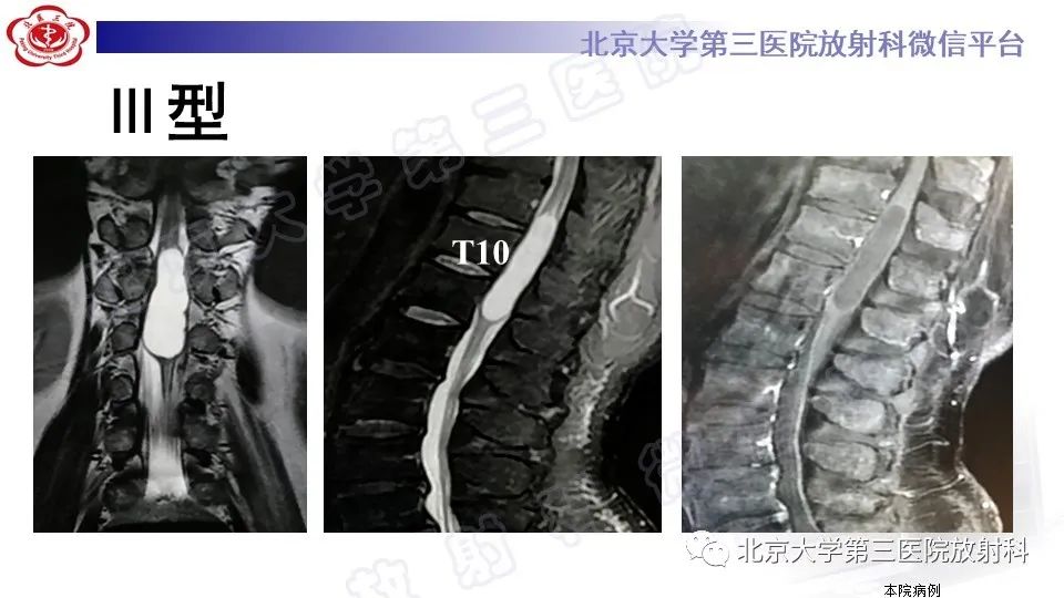 影像PPT - 【PPT】椎管内脊膜囊肿-34