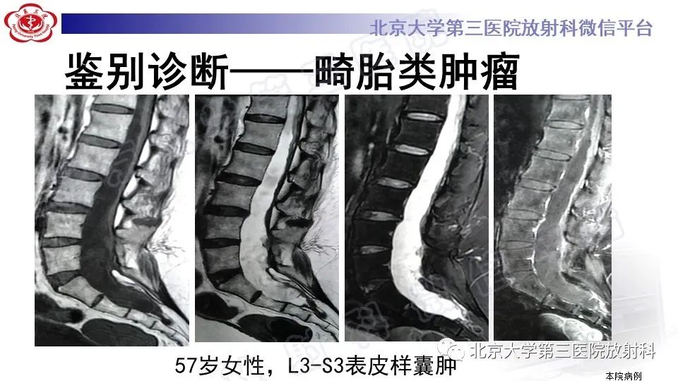 影像PPT - 【PPT】椎管内脊膜囊肿-39