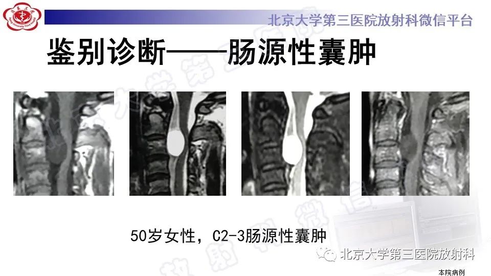 影像PPT - 【PPT】椎管内脊膜囊肿-41