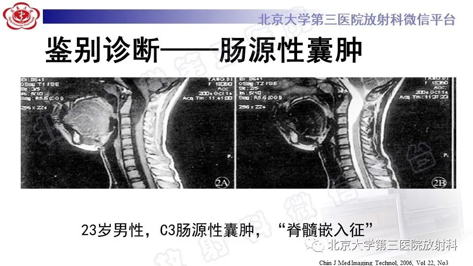 影像PPT - 【PPT】椎管内脊膜囊肿-42