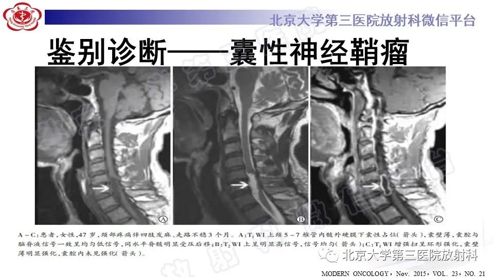 影像PPT - 【PPT】椎管内脊膜囊肿-44