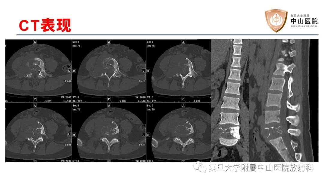 影像PPT - 【病例】脊柱骨巨细胞瘤1例CT及MR影像-4