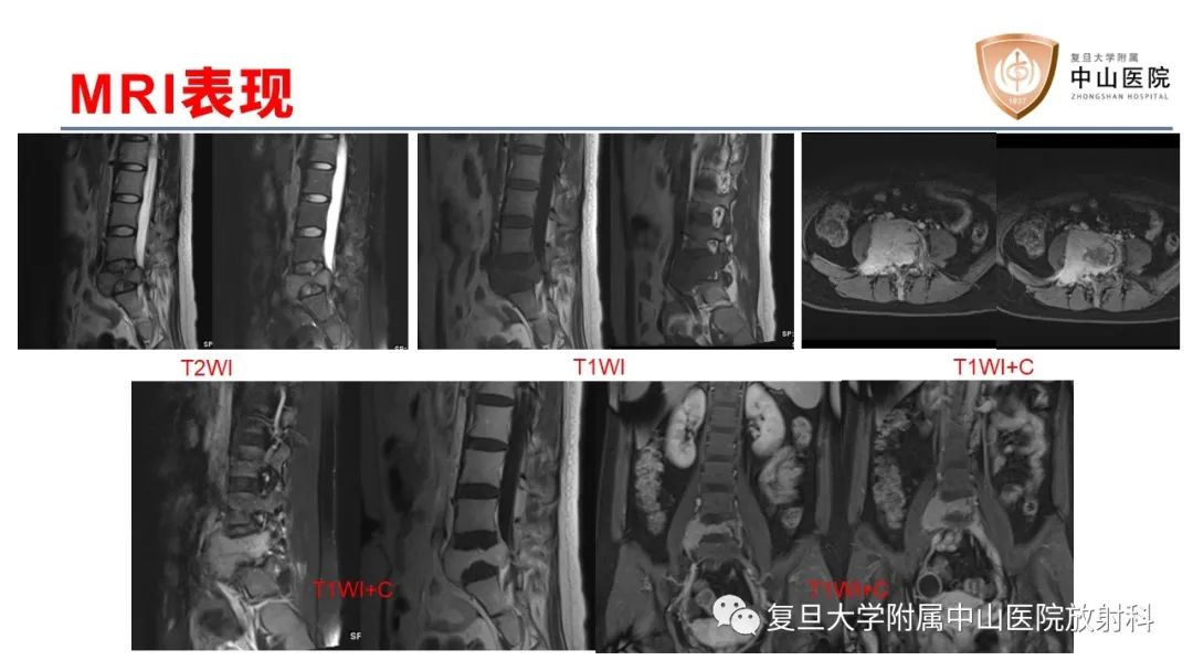 影像PPT - 【病例】脊柱骨巨细胞瘤1例CT及MR影像-5