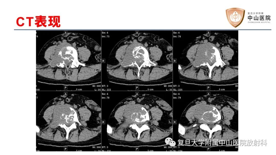影像PPT - 【病例】脊柱骨巨细胞瘤1例CT及MR影像-3