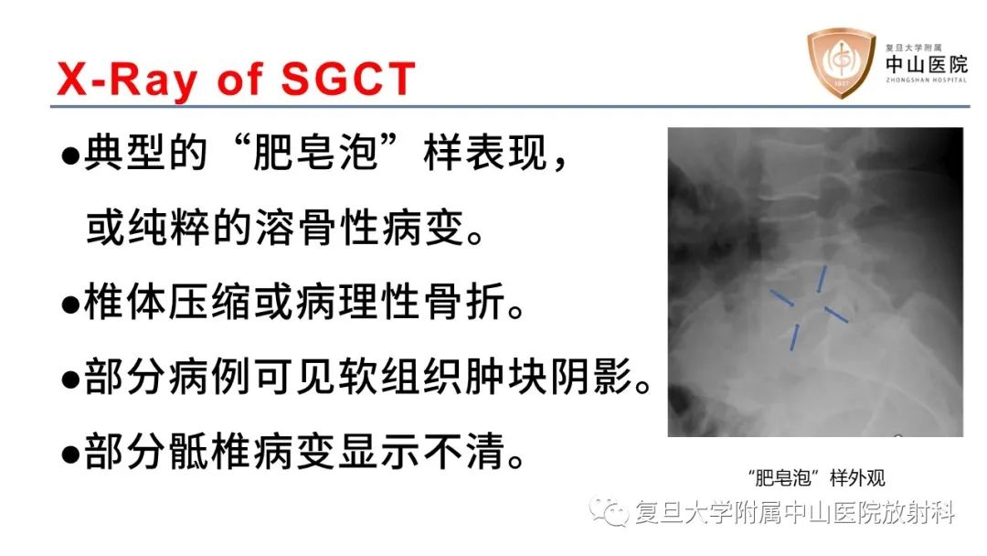 影像PPT - 【病例】脊柱骨巨细胞瘤1例CT及MR影像-13