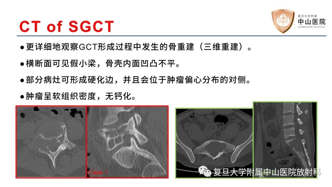 影像PPT - 【病例】脊柱骨巨细胞瘤1例CT及MR影像-14