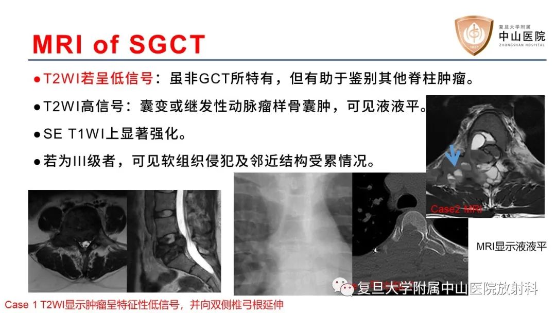 影像PPT - 【病例】脊柱骨巨细胞瘤1例CT及MR影像-15