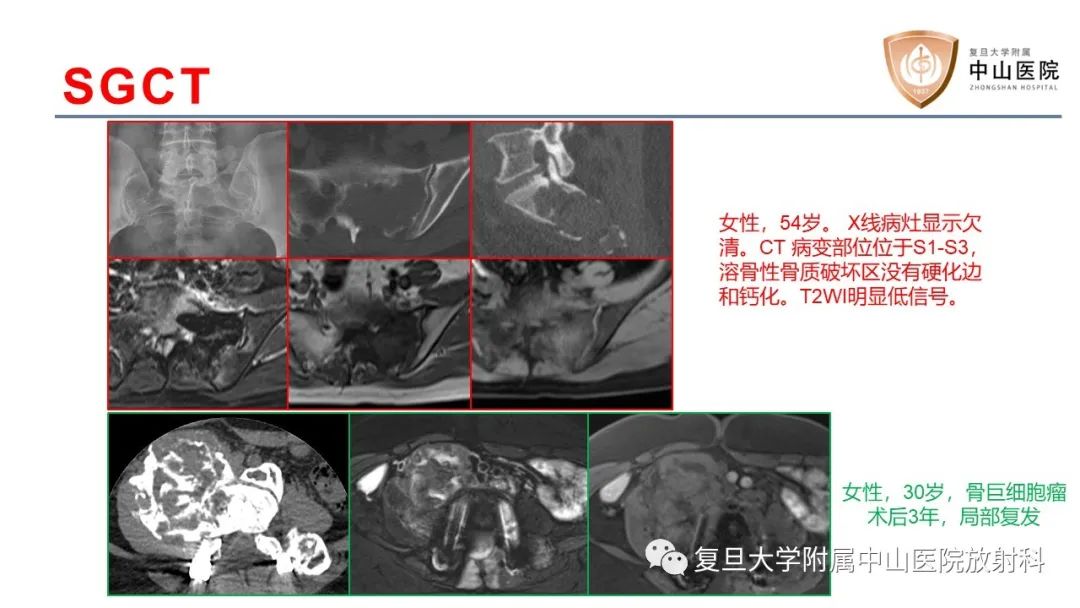 影像PPT - 【病例】脊柱骨巨细胞瘤1例CT及MR影像-16