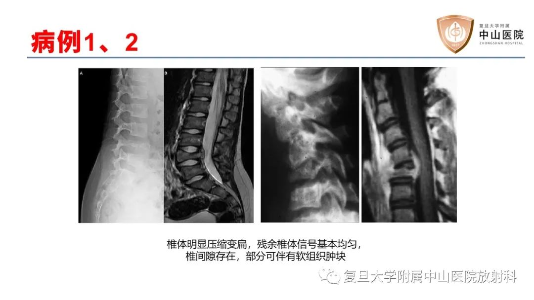 影像PPT - 【病例】脊柱骨巨细胞瘤1例CT及MR影像-19