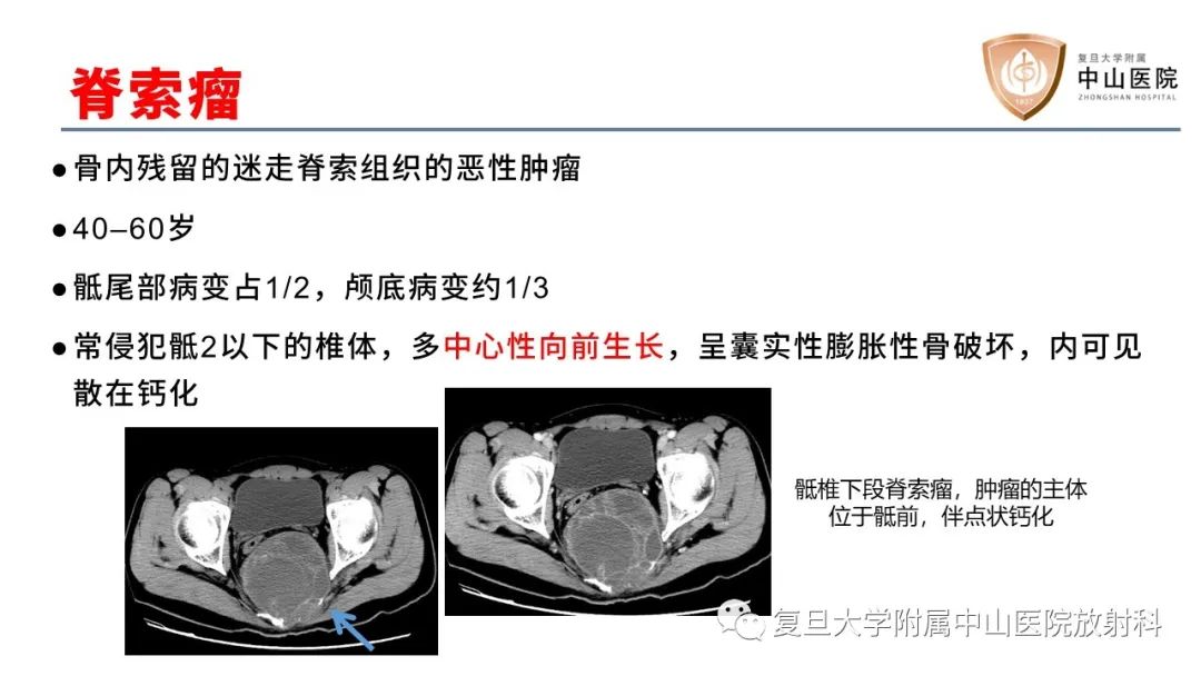 影像PPT - 【病例】脊柱骨巨细胞瘤1例CT及MR影像-20