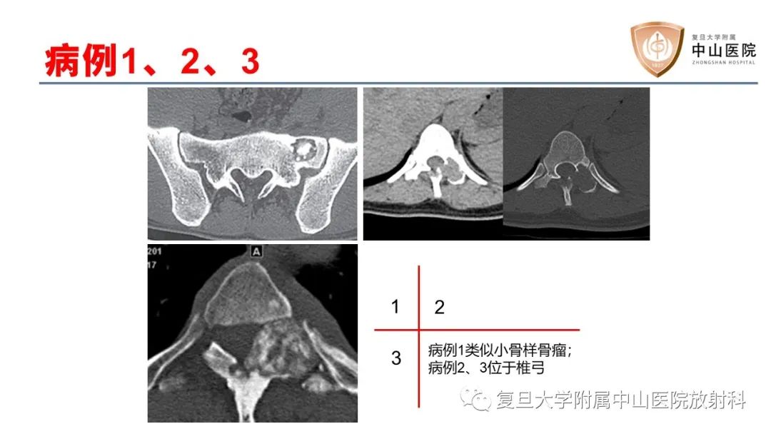 影像PPT - 【病例】脊柱骨巨细胞瘤1例CT及MR影像-22