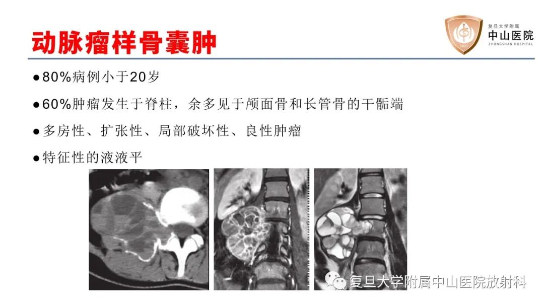 影像PPT - 【病例】脊柱骨巨细胞瘤1例CT及MR影像-23