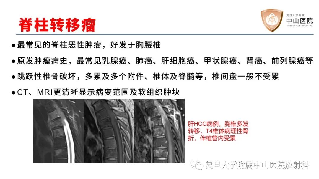 影像PPT - 【病例】脊柱骨巨细胞瘤1例CT及MR影像-24