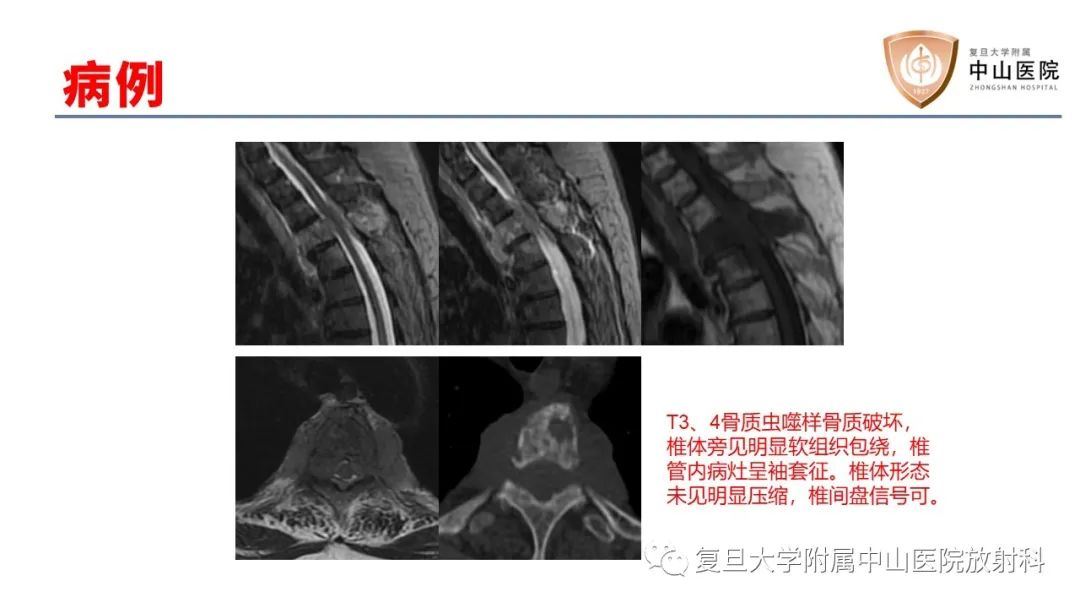 影像PPT - 【病例】脊柱骨巨细胞瘤1例CT及MR影像-26
