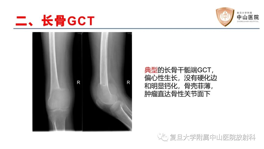 影像PPT - 【病例】脊柱骨巨细胞瘤1例CT及MR影像-27