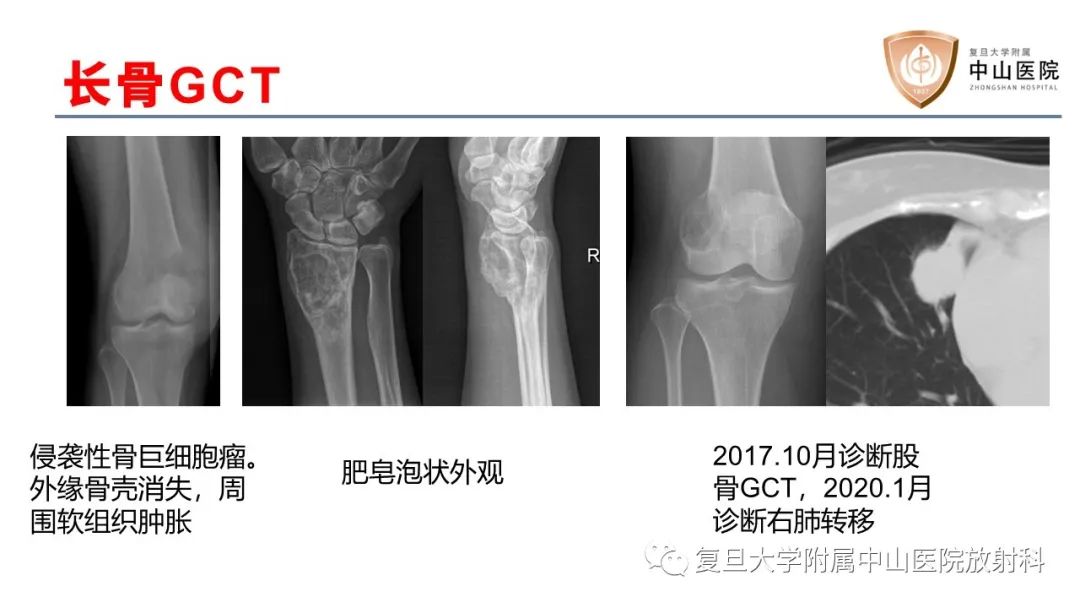 影像PPT - 【病例】脊柱骨巨细胞瘤1例CT及MR影像-28