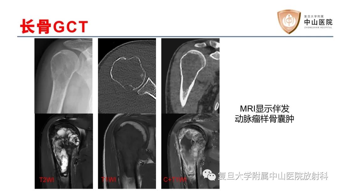 影像PPT - 【病例】脊柱骨巨细胞瘤1例CT及MR影像-29