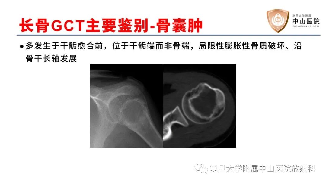 影像PPT - 【病例】脊柱骨巨细胞瘤1例CT及MR影像-30