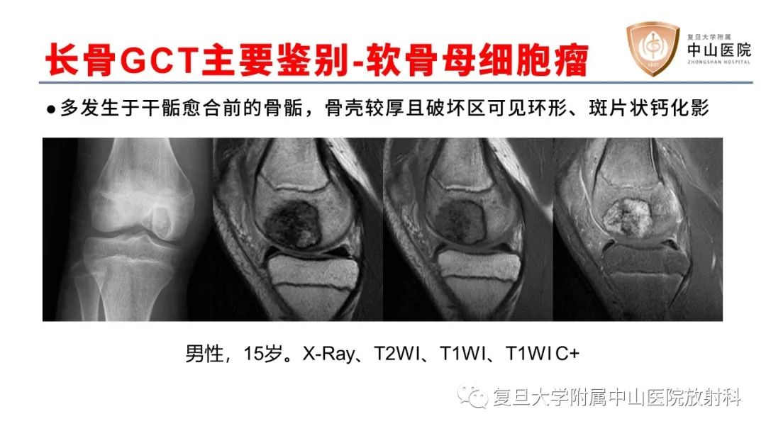 影像PPT - 【病例】脊柱骨巨细胞瘤1例CT及MR影像-31