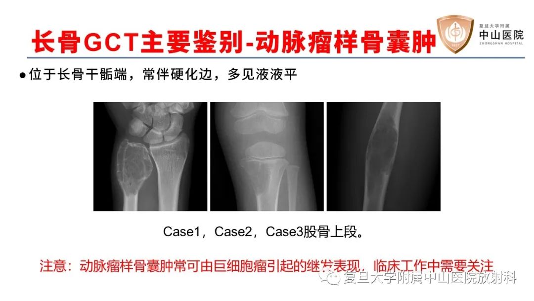 影像PPT - 【病例】脊柱骨巨细胞瘤1例CT及MR影像-32