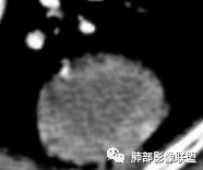 影像PPT - 【病例】外周胸膜下类圆形肿块—鳞癌与肉瘤样癌的纠结-17 影像PPT - 【病例】外周胸膜下类圆形肿块—鳞癌与肉瘤样癌的纠结-17