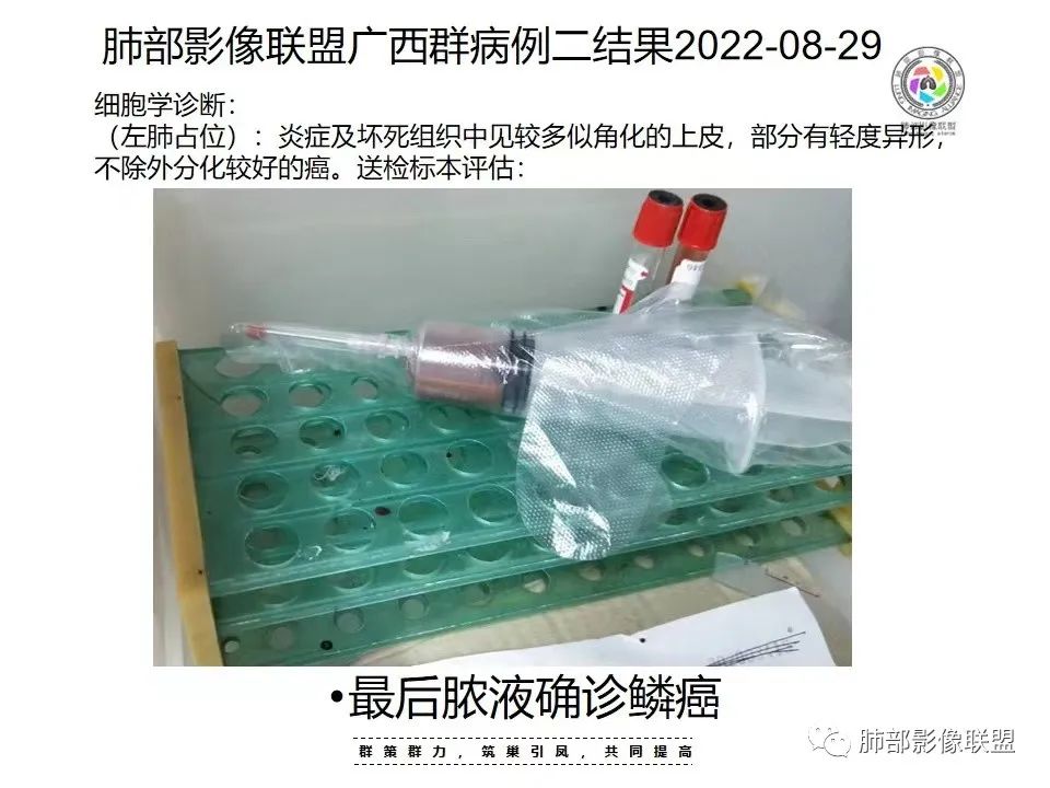 影像PPT - 【病例】外周胸膜下类圆形肿块—鳞癌与肉瘤样癌的纠结-18 影像PPT - 【病例】外周胸膜下类圆形肿块—鳞癌与肉瘤样癌的纠结-18