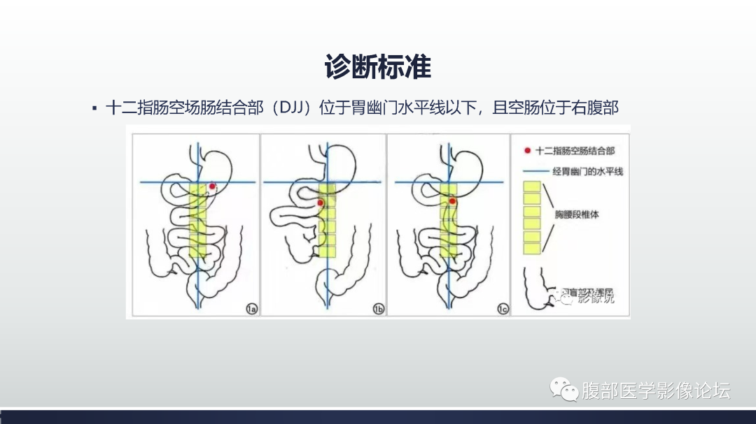 影像PPT - 【病例】中肠旋转不良1例CT影像-8