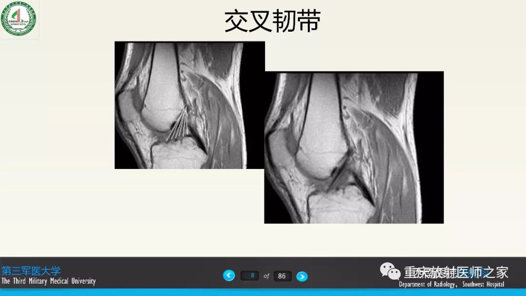影像PPT - 【PPT】膝关节韧带MRI诊断要点-8
