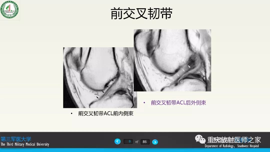 影像PPT - 【PPT】膝关节韧带MRI诊断要点-9