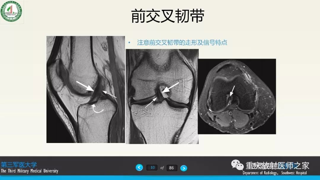 影像PPT - 【PPT】膝关节韧带MRI诊断要点-10
