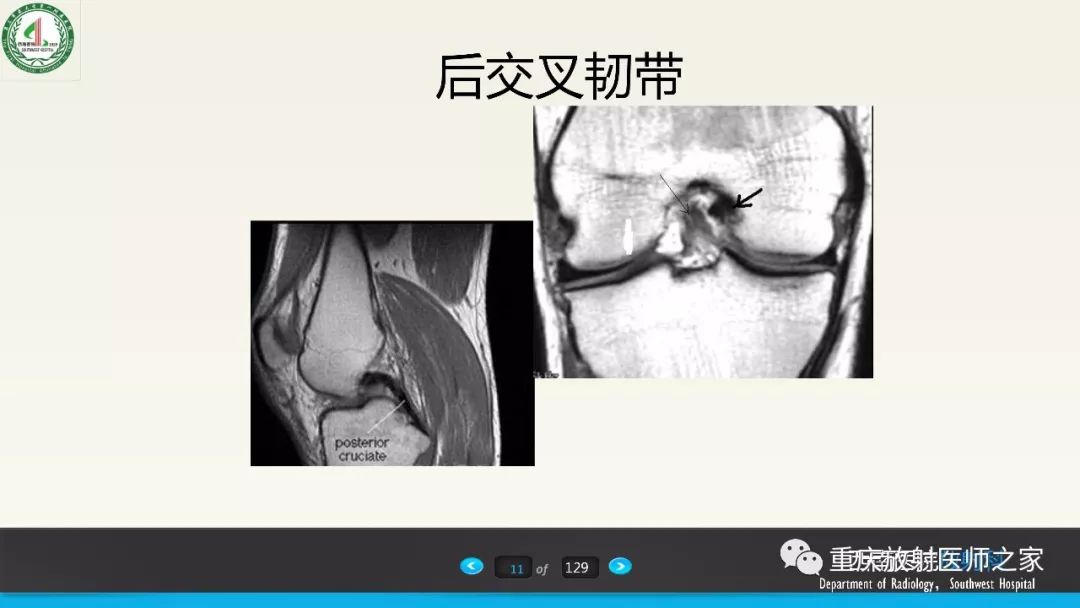 影像PPT - 【PPT】膝关节韧带MRI诊断要点-11
