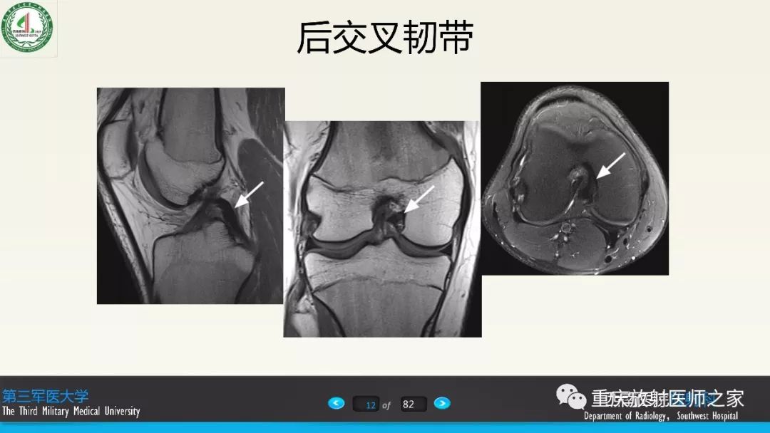 影像PPT - 【PPT】膝关节韧带MRI诊断要点-12