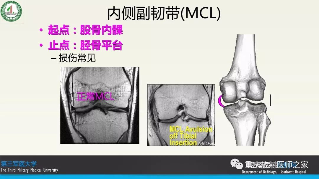 影像PPT - 【PPT】膝关节韧带MRI诊断要点-13