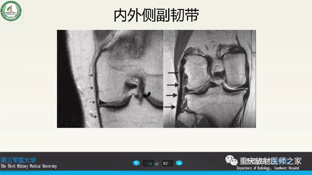影像PPT - 【PPT】膝关节韧带MRI诊断要点-16