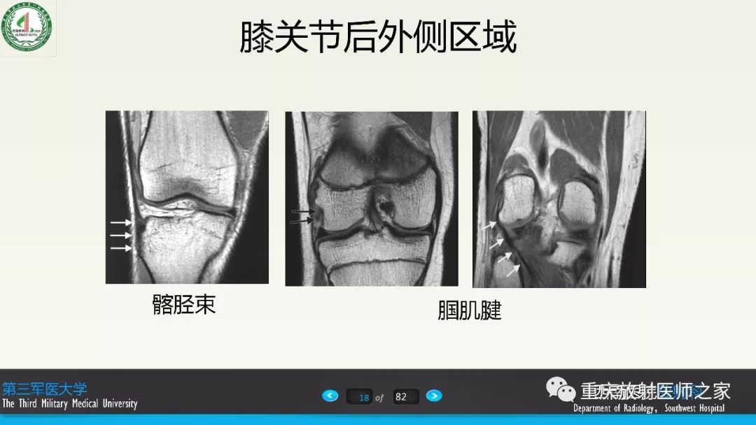 影像PPT - 【PPT】膝关节韧带MRI诊断要点-18