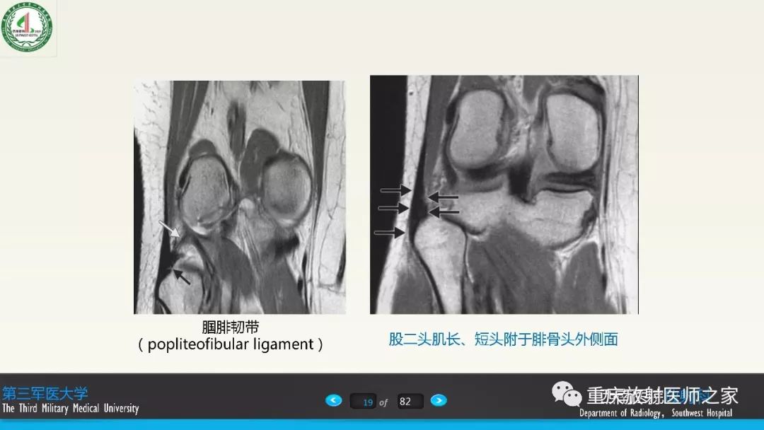 影像PPT - 【PPT】膝关节韧带MRI诊断要点-19