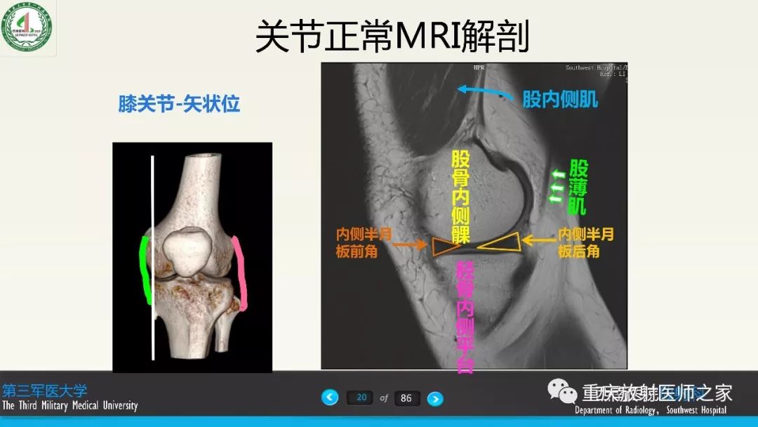 影像PPT - 【PPT】膝关节韧带MRI诊断要点-20