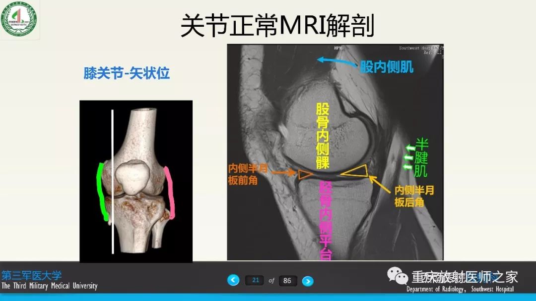 影像PPT - 【PPT】膝关节韧带MRI诊断要点-21