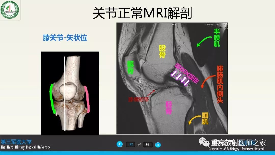 影像PPT - 【PPT】膝关节韧带MRI诊断要点-22