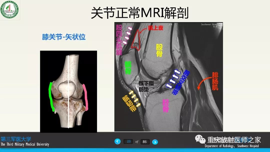 影像PPT - 【PPT】膝关节韧带MRI诊断要点-23