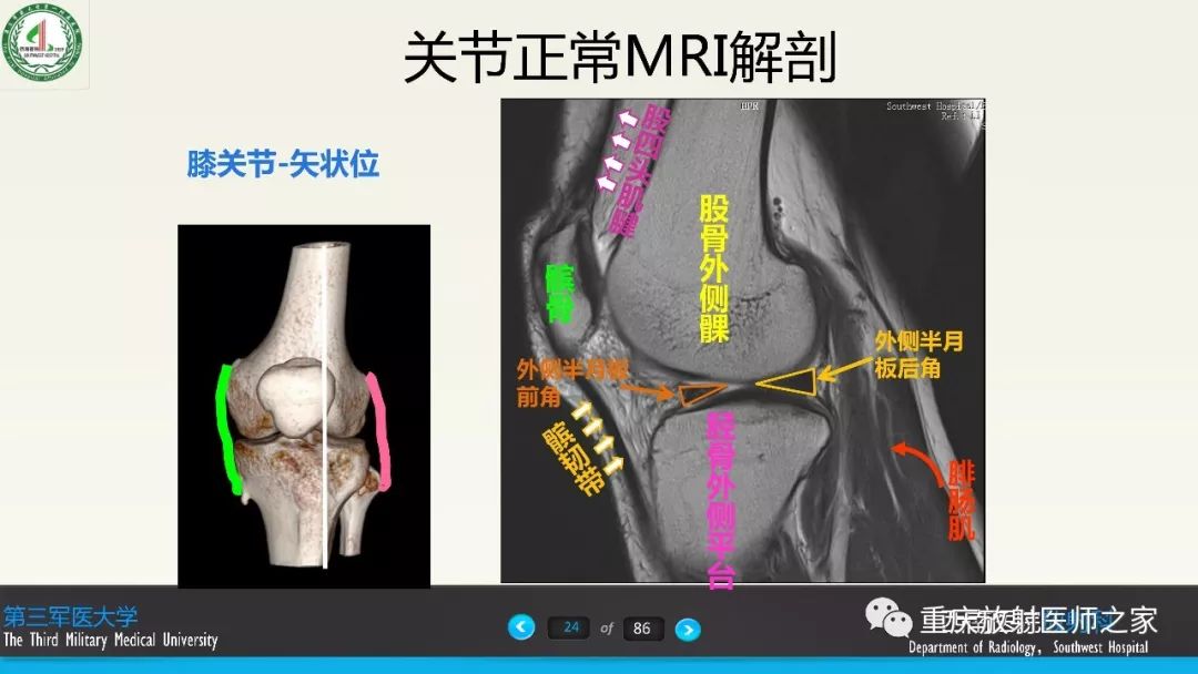 影像PPT - 【PPT】膝关节韧带MRI诊断要点-24