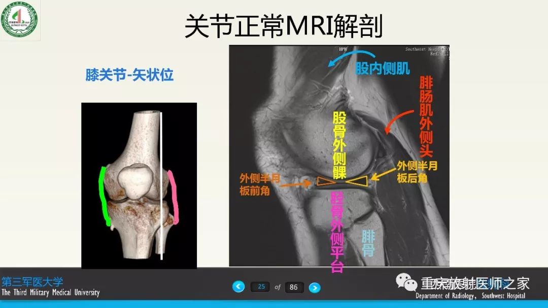 影像PPT - 【PPT】膝关节韧带MRI诊断要点-25