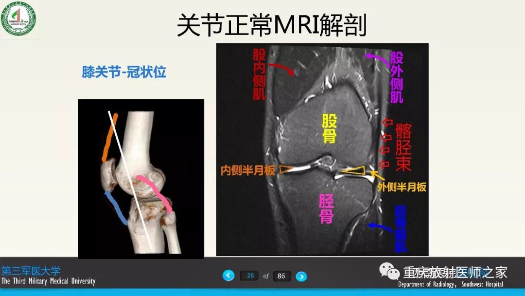 影像PPT - 【PPT】膝关节韧带MRI诊断要点-26