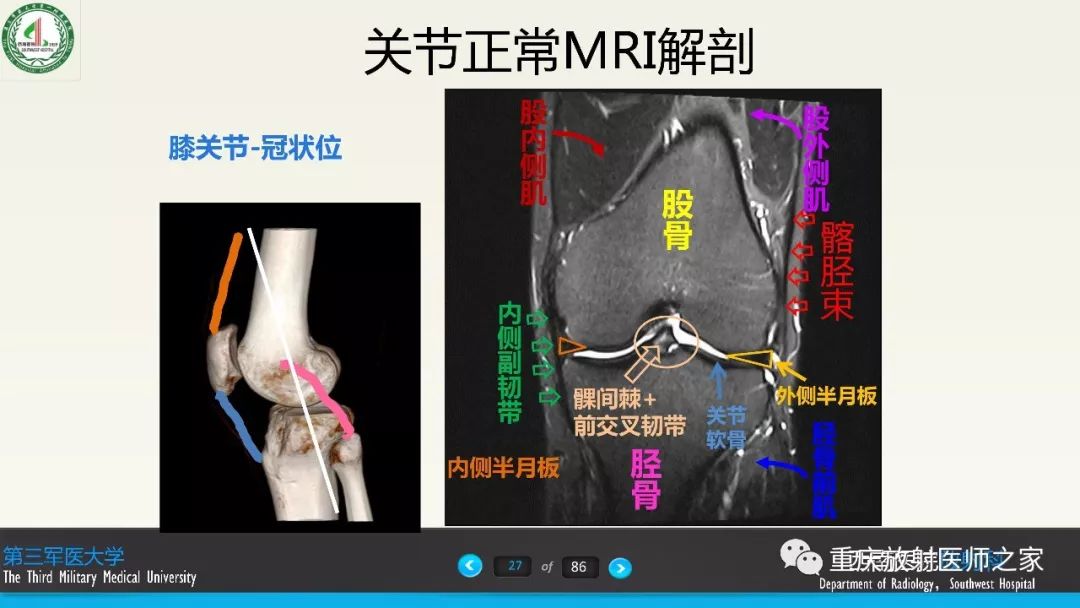 影像PPT - 【PPT】膝关节韧带MRI诊断要点-27