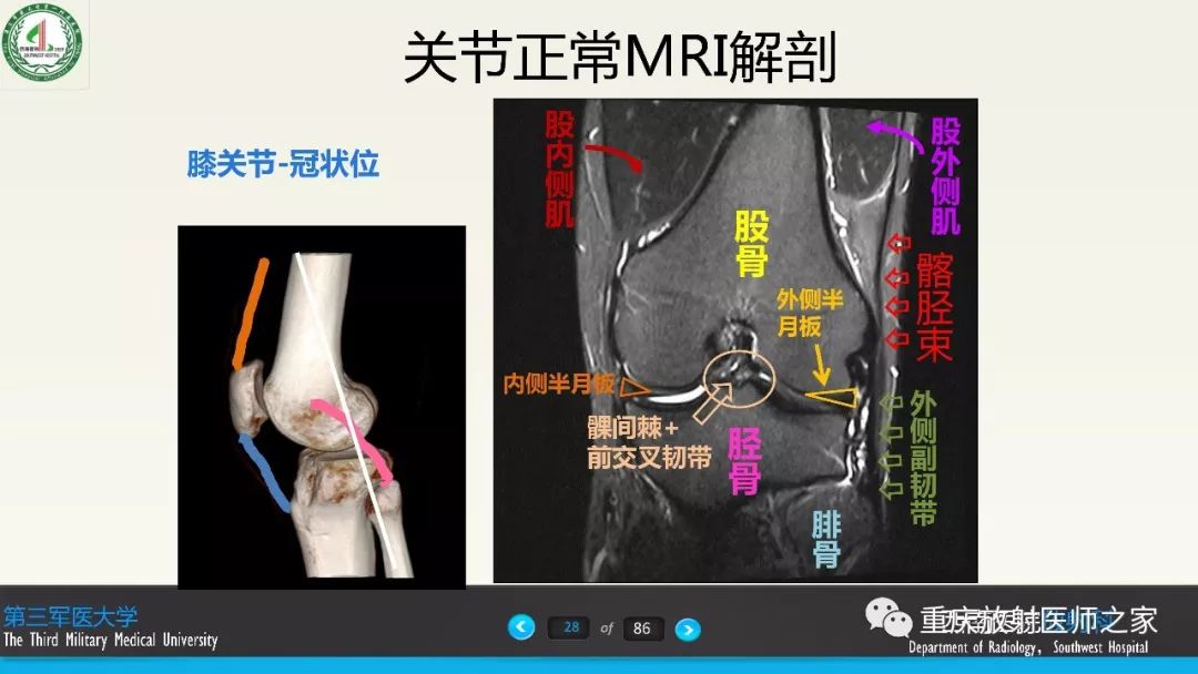 影像PPT - 【PPT】膝关节韧带MRI诊断要点-28