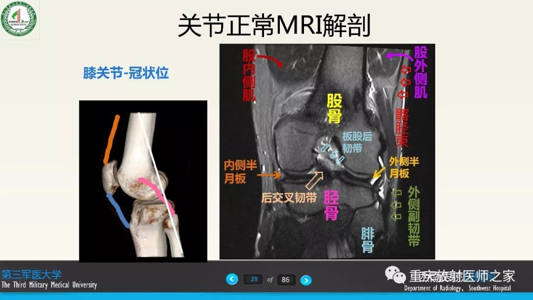 影像PPT - 【PPT】膝关节韧带MRI诊断要点-29