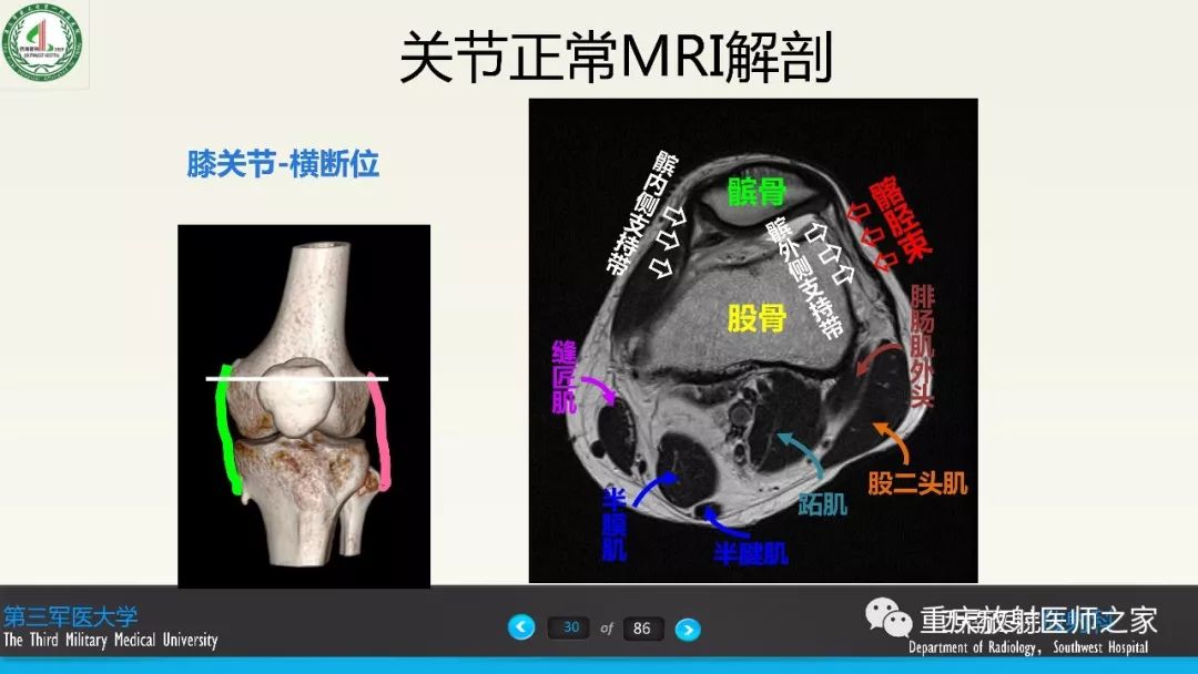影像PPT - 【PPT】膝关节韧带MRI诊断要点-30
